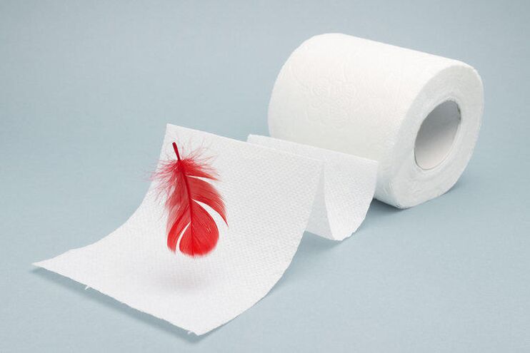 Bloed op toiletpapier is een teken van aambeien